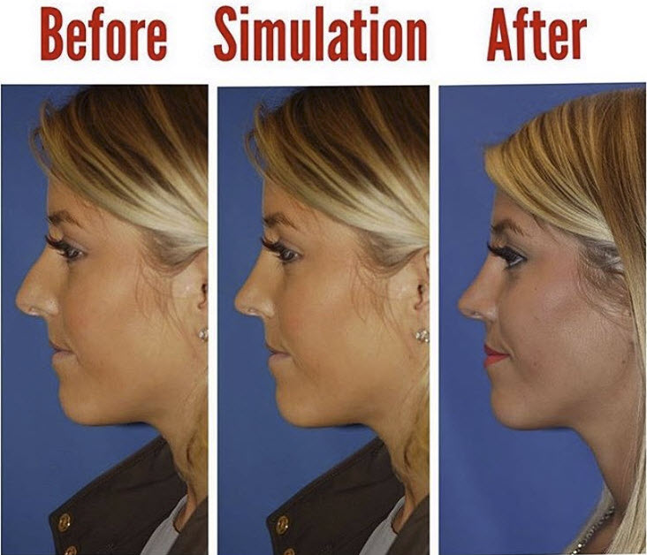 open rhinoplasty before and after